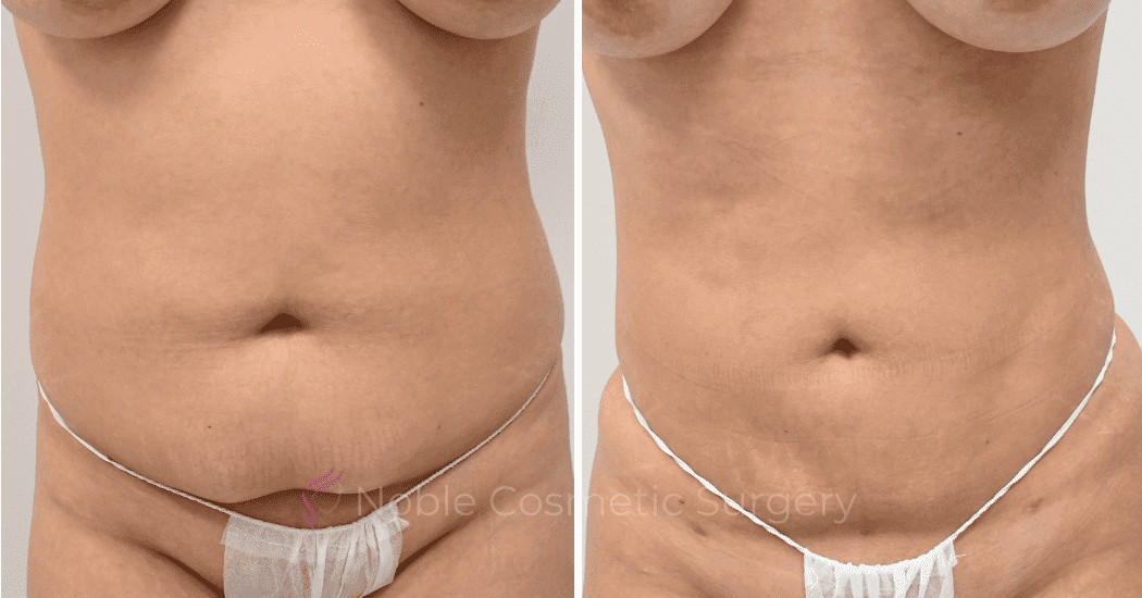 LIPOSUCTION-CASE-12977 | Before and After Liposuction 1