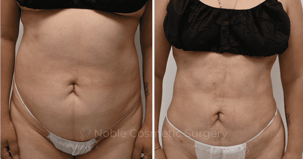 LIPOSUCTION-CASE-11116 | Before and After Liposuction 1