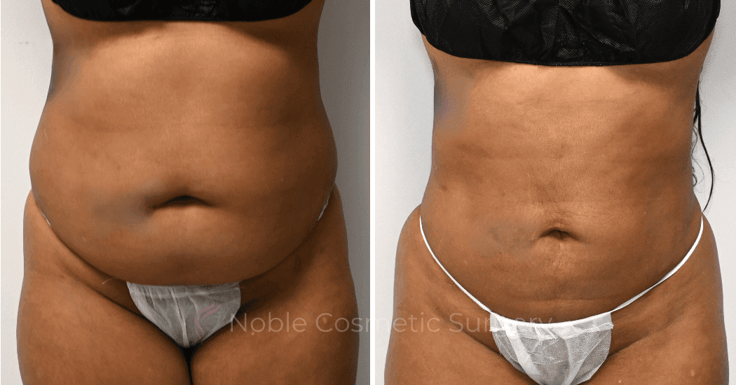 LIPOSUCTION-CASE-10929 | Before and After Liposuction 1