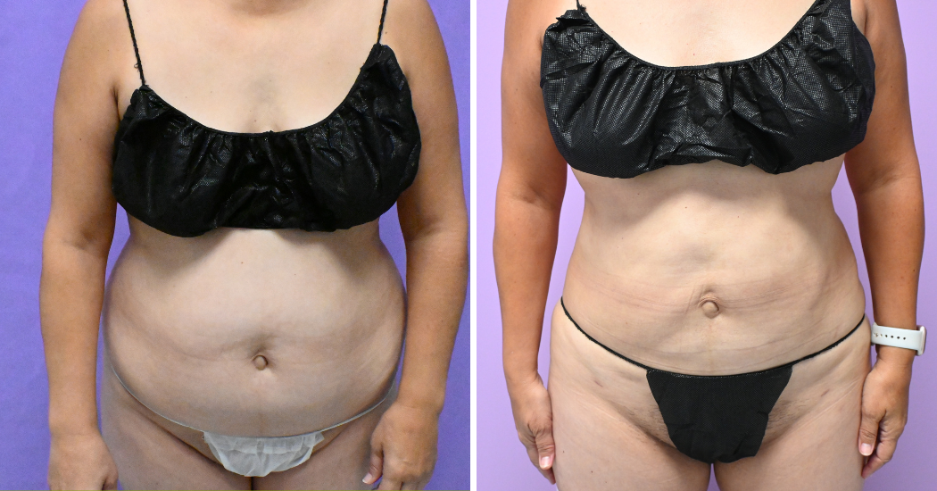 Case---19506 | Before and After Liposuction