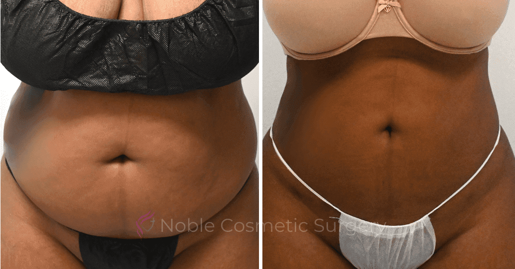 LIPOSUCTION-CASE-10271 | Before and After Liposuction 1