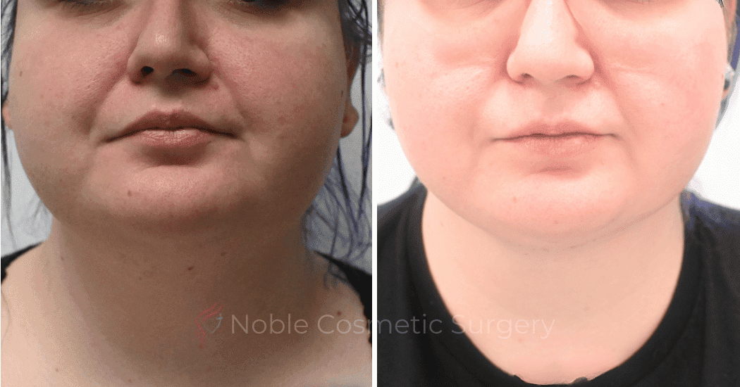 LIPOSUCTION-SUBMENTAL-CASE-19114 | Before and After Face