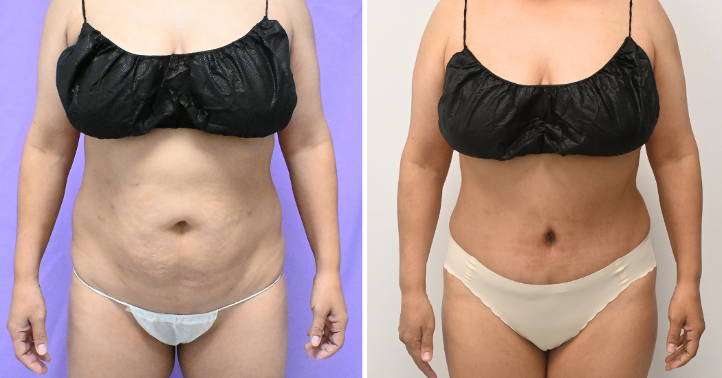 Case--20157 | Before and After Abdominoplasty