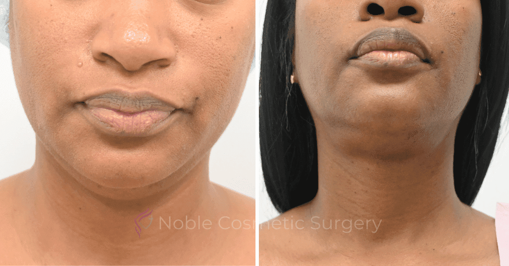 SUBMENTAL-LIPOSUCTION-CASE-12998 | Before and After Face