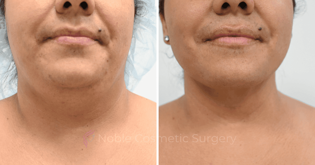 SUBMENTAL-LIPOSUCTION-CASE-12466 | Before and After Face
