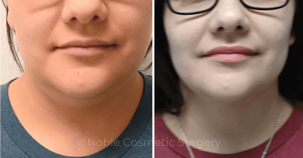 SUBMENTAL-LIPOSUCTION-CASE-10173 | Before and After Face