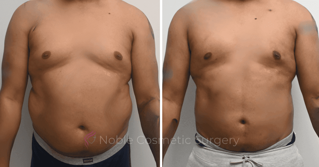 LIPOSUCTION-ABDOMEN-CASE-10135 | Before and After Men