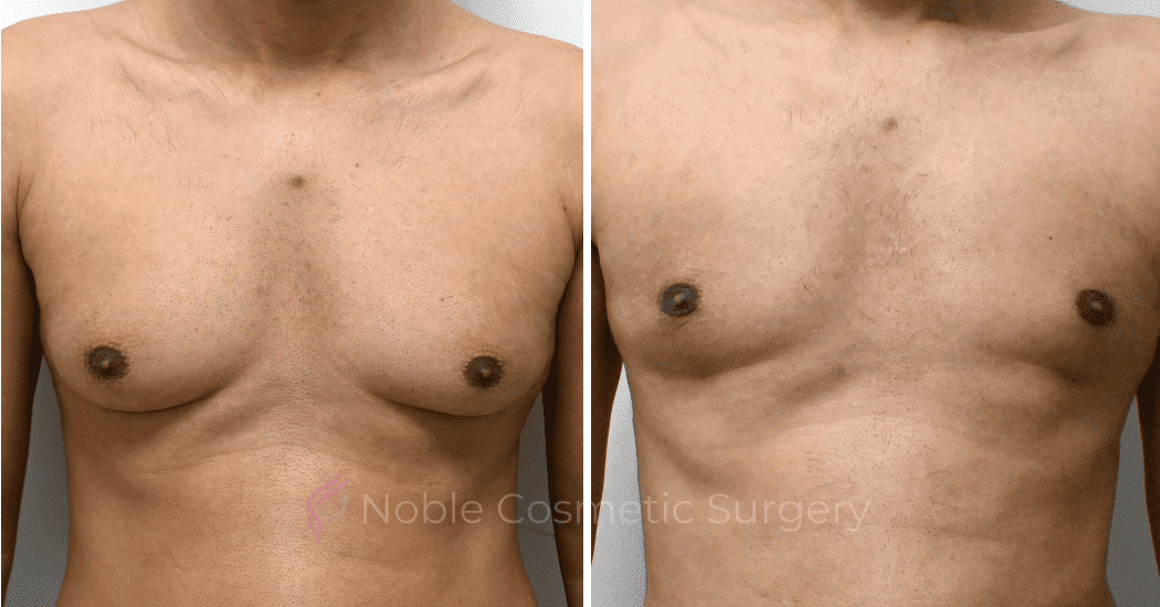 GYNECOMASTIA-CASE-10707 | Before and After Men