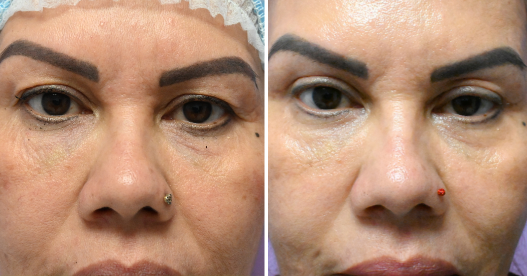 Case--20485 | Before and After Blepharoplasty 1