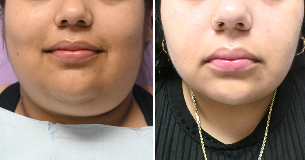 Case--10492 | Before and After Chin Liposuction 1