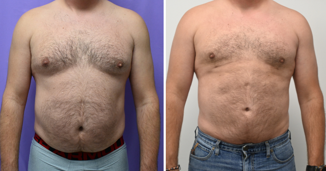 Case---13711 | Before and After Male Liposuction
