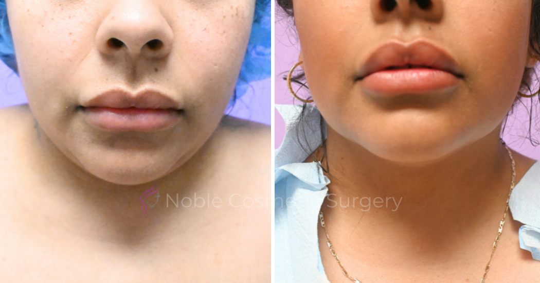 Case--20274 | Before and After Chin Liposuction 1
