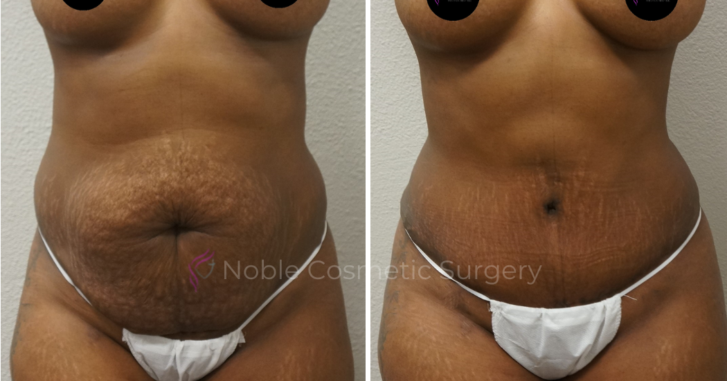 TUMMY-TUCK-CASE-00046 | Before and After Abdominoplasty 1