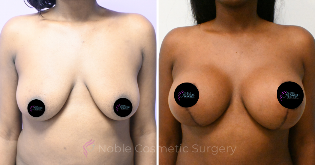 Case--5094 | Before and After Breast Augmentation with Lift