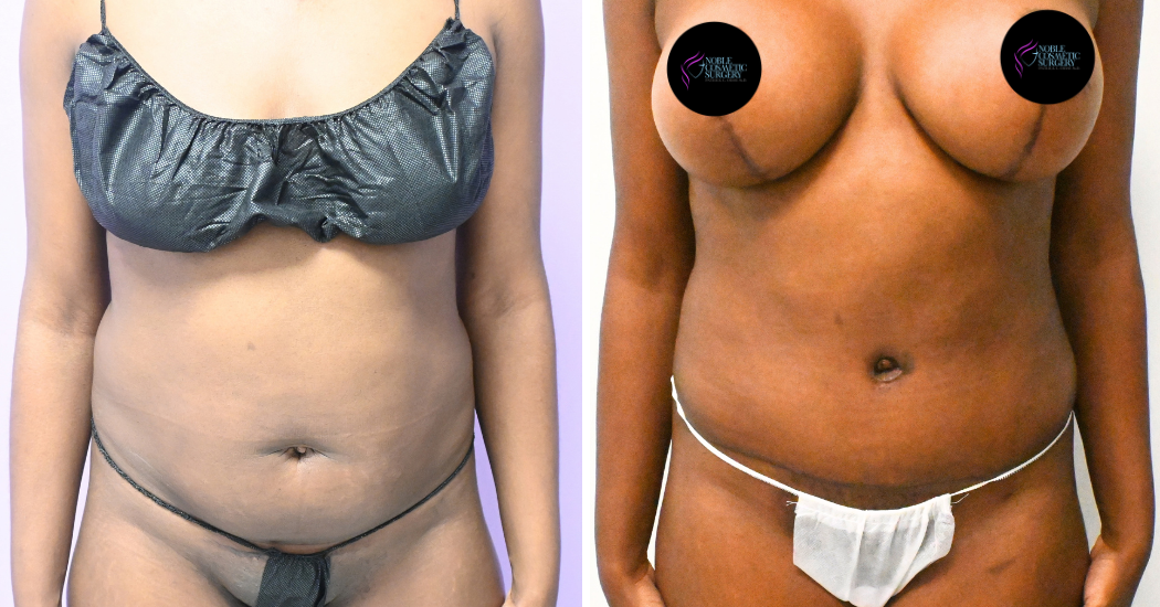 Case--20347 | Before and After Abdominoplasty