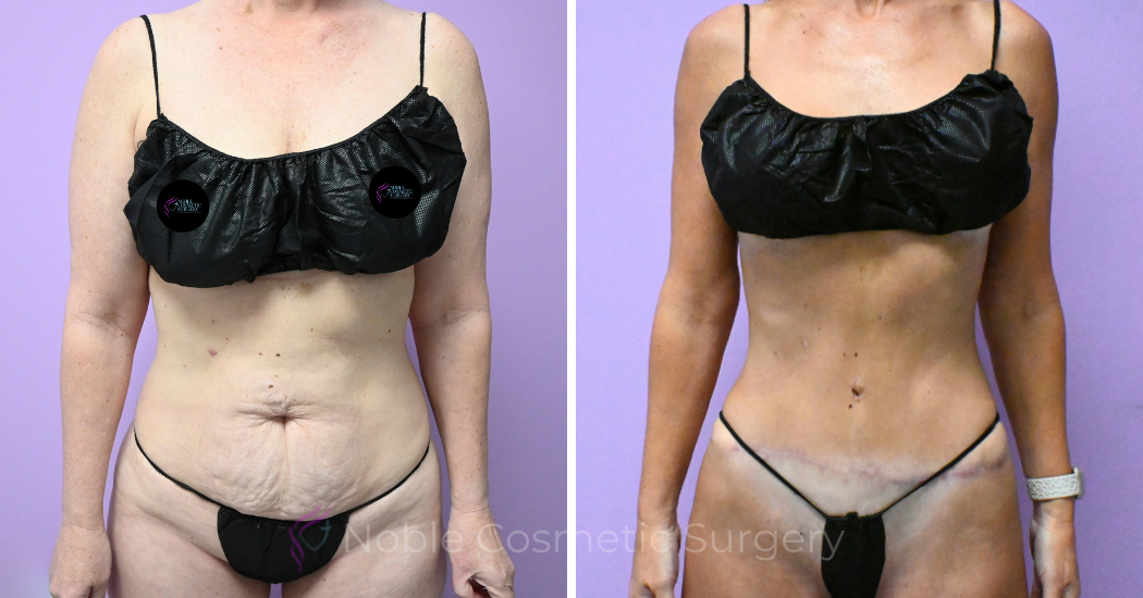 -20309 | Before and After Abdominoplasty