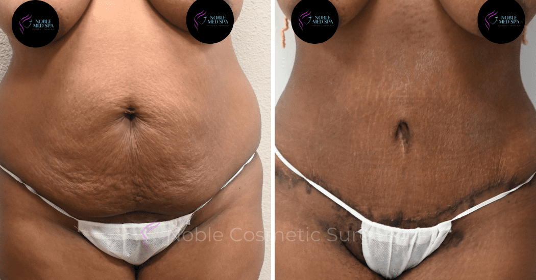 TUMMY-TUCK-CASE-13859 | Before and After Abdominoplasty 1