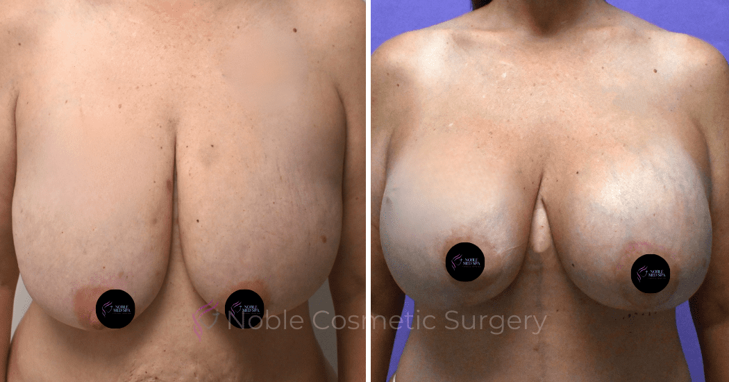 BREAST-AUGMENTATION-WITH-LIFT-CASE-10275 | Before and After Breast