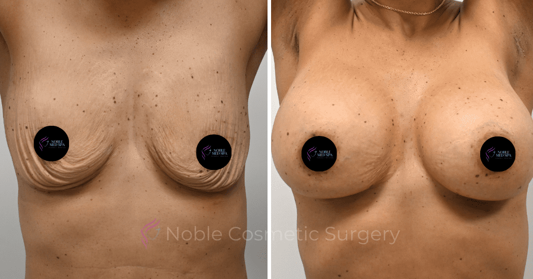 BREAST-AUGMENTATION-CASE-13021 | Before and After Breast