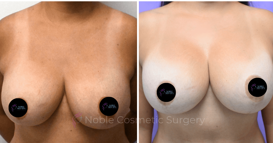 BREAST-AUGMENTATION--CASE-00310 | Before and After Breast