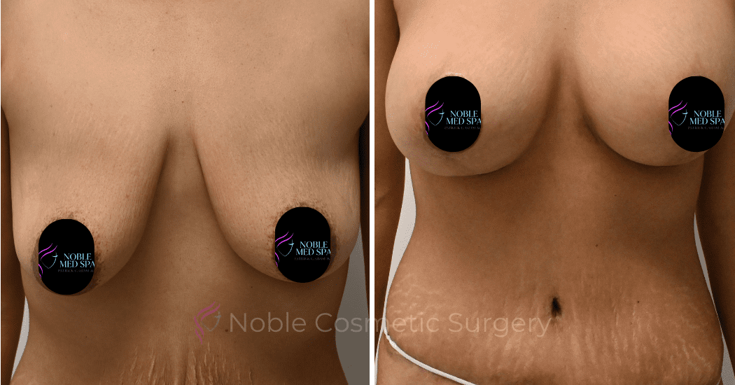 BREAST-AUGMENTATION-WITH-LIFT-CASE-10931 | Before and After Breast