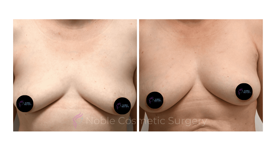 BREAST-AUGUMENTATION-WITH-FAT-TRANSFER-CASE-00260 | Before and After Breast Augmentation 1