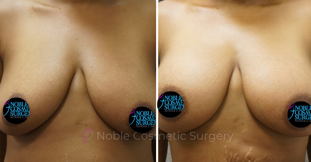 BREAST-AUGMENTATION--WITH-FAT-TRANSFER--CASE-00268 | Before and After Breast Augmentation 1