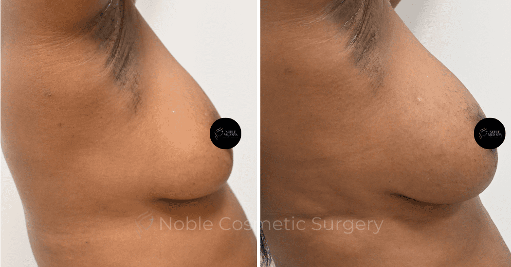 BREAST-AUGMENTATION-WITH-FAT-TRANSFER-CASE-00261 | Before and After Breast Augmentation 1