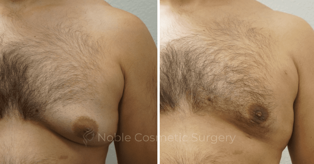 GYNECOMASTIA--CASE-16730 | Before and After Men