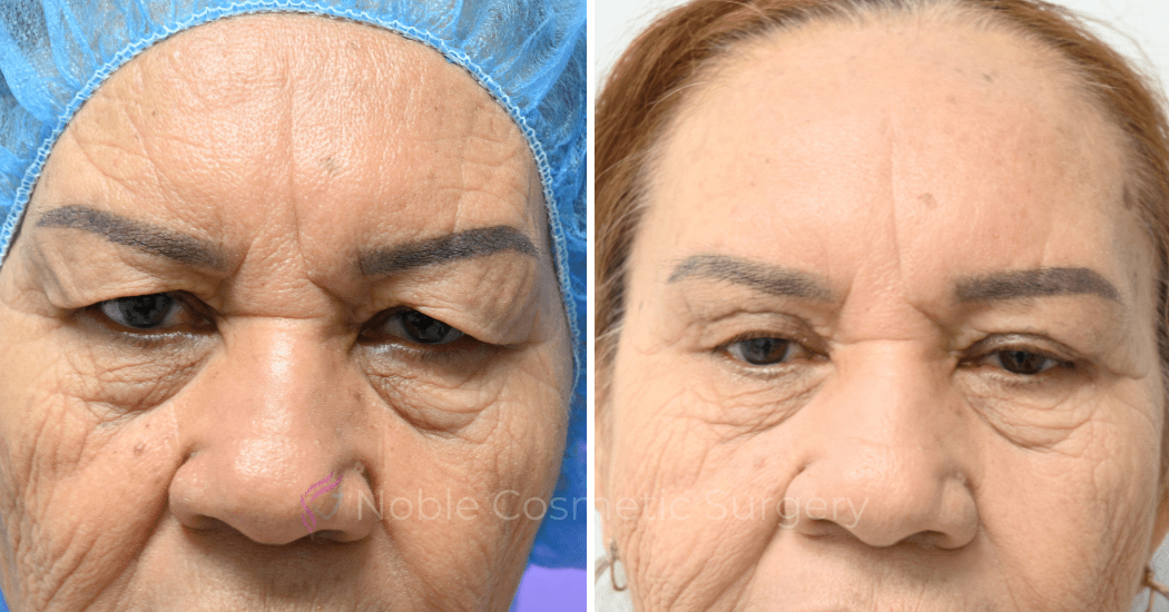 BLEPHAROPLASTY-CASE-10180 | Before and After Blepharoplasty 1