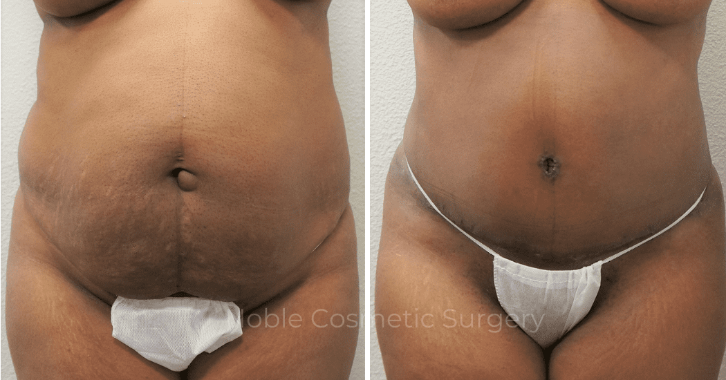 TUMMY-TUCK-CASE-00306 | Before and After Abdominoplasty 1