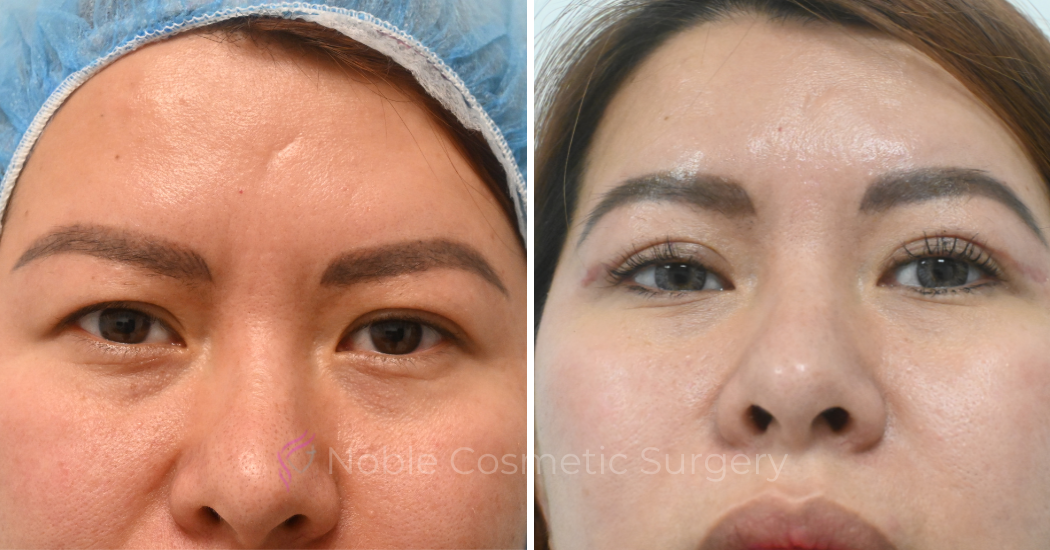 BLEPHAROPLASTY-CASE-10083 | Before and After Blepharoplasty 1