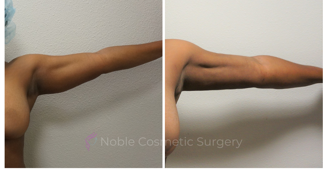 LIPOSUCTION-ARMS-CASE-00500 | Before and After Body