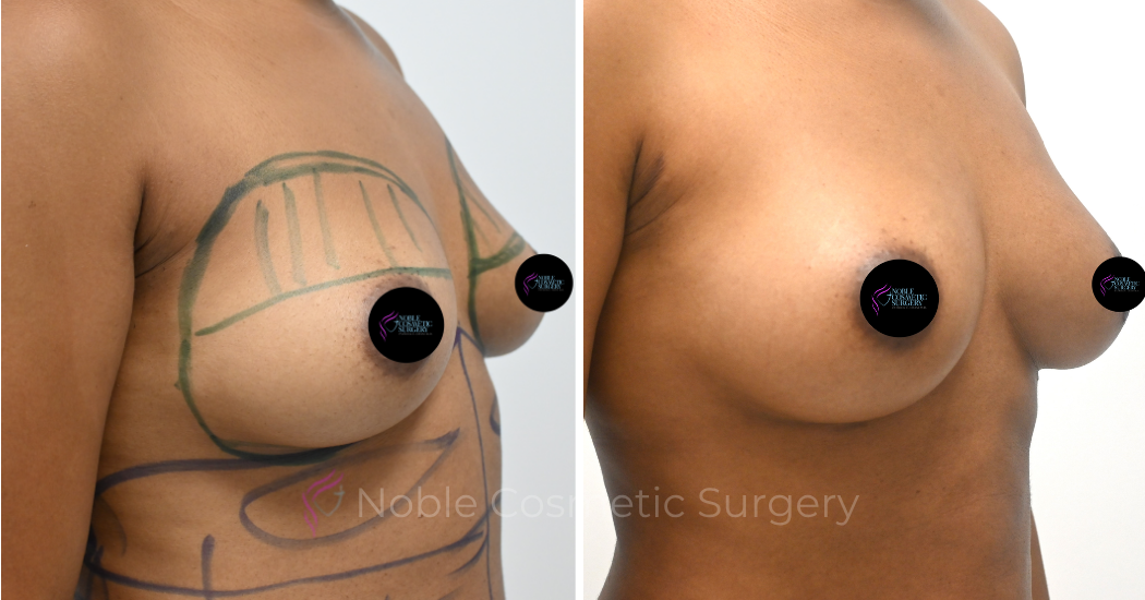 BREAST-AUGMENTATION--WITH-FAT-TRANSFER--CASE-11111 | Before and After Breast Augmentation 1