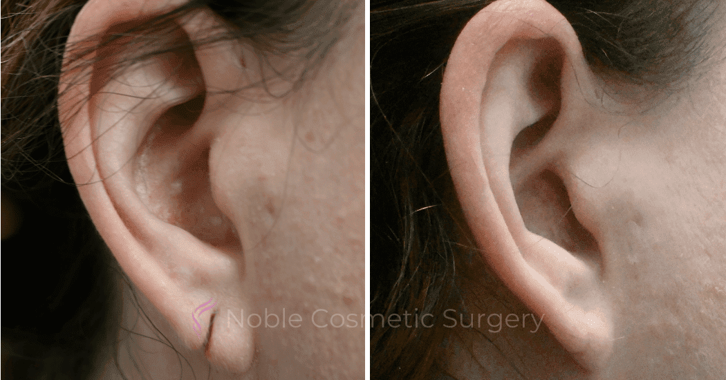 Earlobe-Repair-Case-20256 | Before and After Face