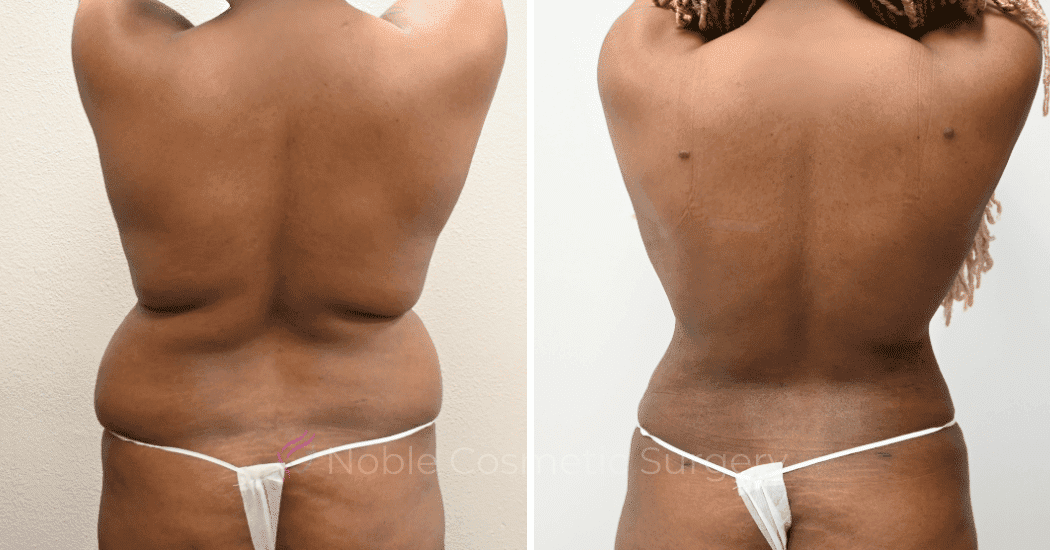 LIPOSUCTION-CASE-13859 | Before and After Liposuction 1