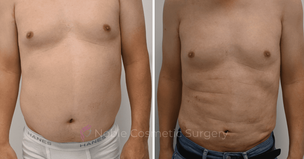 LIPOSUCTION-ABDOMEN-CASE-12252 | Before and After Men