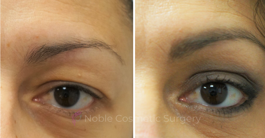 BLEPHAROPLASTY-CASE-16936 | Before and After Blepharoplasty 1