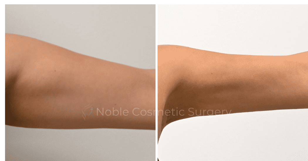 LIPOSUCTION-ARMS-CASE-00316 | Before and After Body