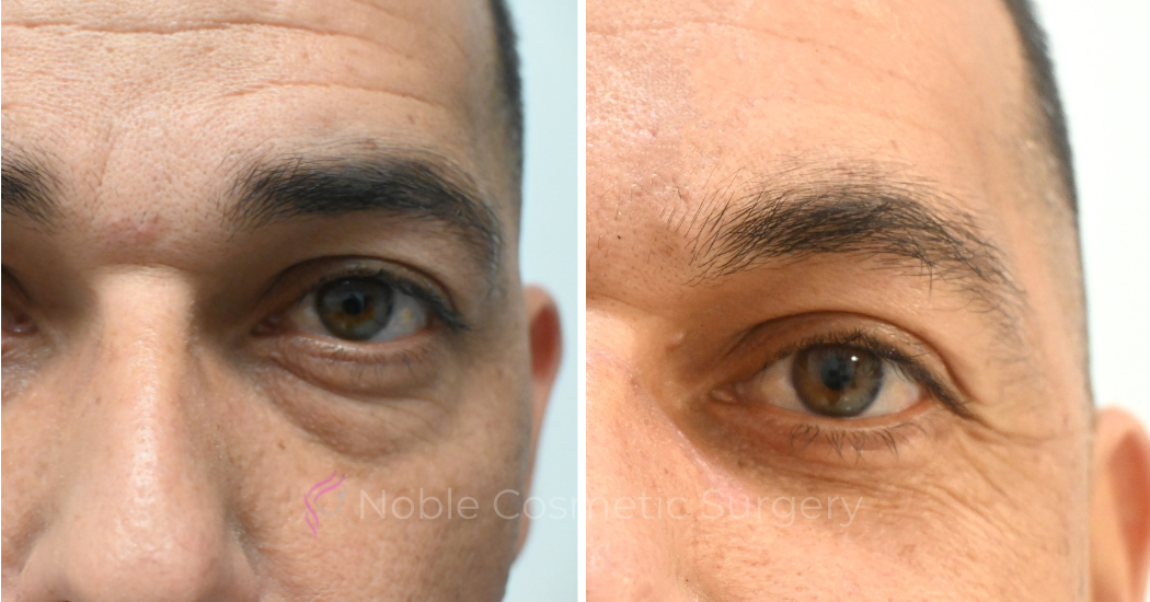 BLEPHAROPLASTY-CASE-10655 | Before and After Blepharoplasty 1