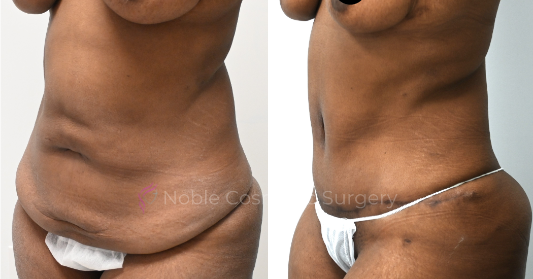 TUMMY-TUCK-CASE-10784 | Before and After Abdominoplasty 2