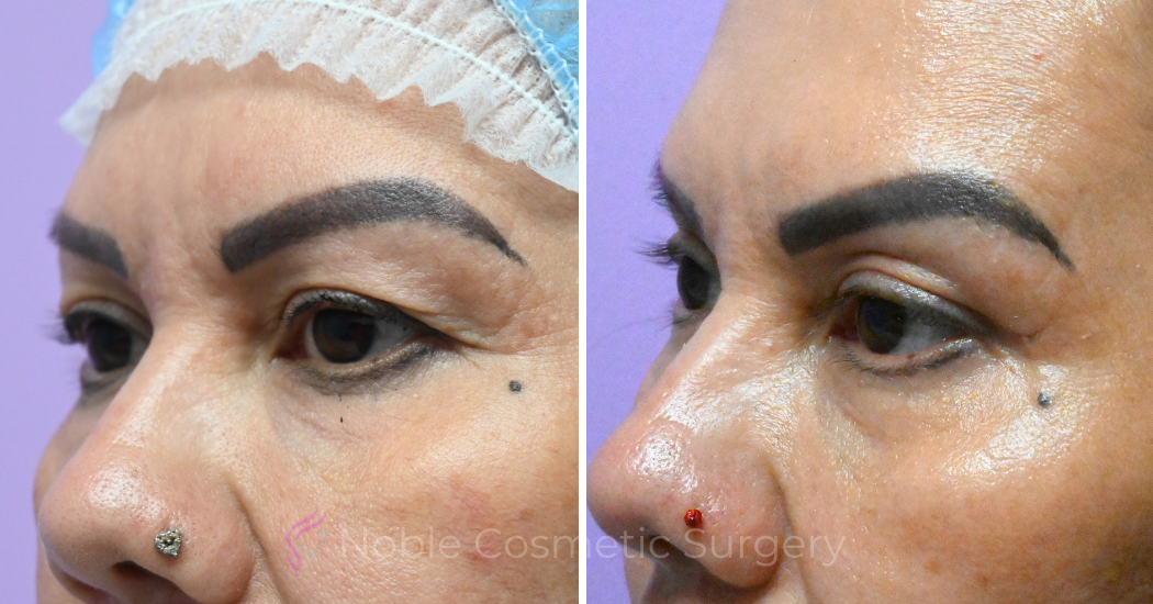 Case--20485 | Before and After Blepharoplasty 2