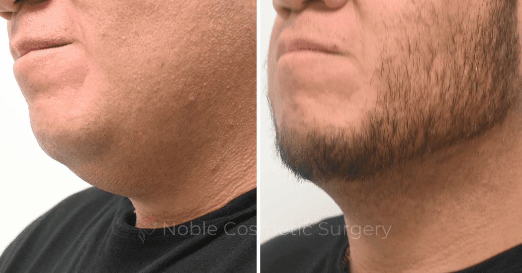 SUBMENTAL-LIPOSUCTION-CASE-19137 | Before and After Face