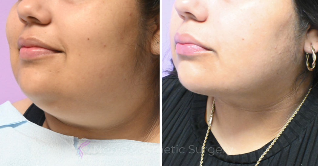 Case--10492 | Before and After Chin Liposuction 2