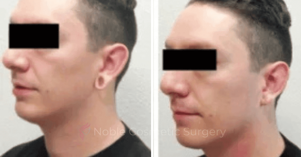 Earlobe-Repair-Case-20254 | Before and After Face