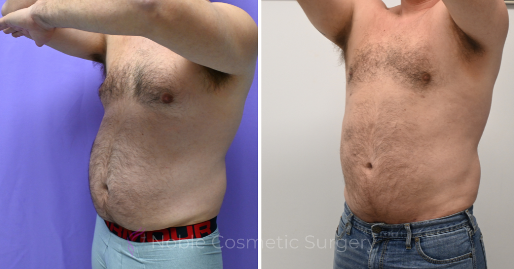 Case---13711 | Before and After Male Liposuction 2