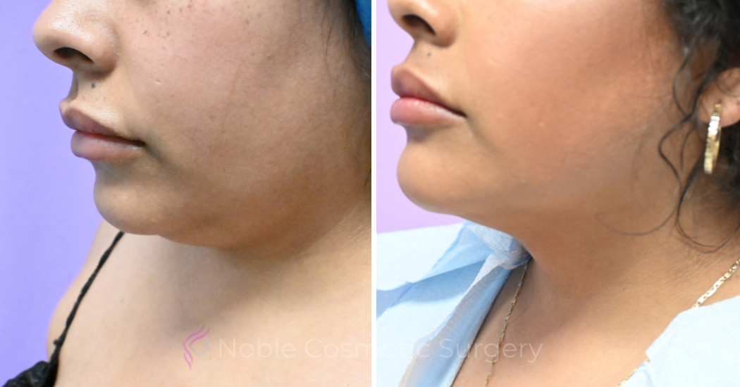 Case--20274 | Before and After Chin Liposuction 2
