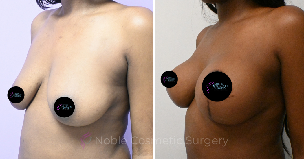 Case--5094 | Before and After Breast Augmentation with Lift 2