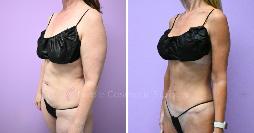 -20309 | Before and After Abdominoplasty 2