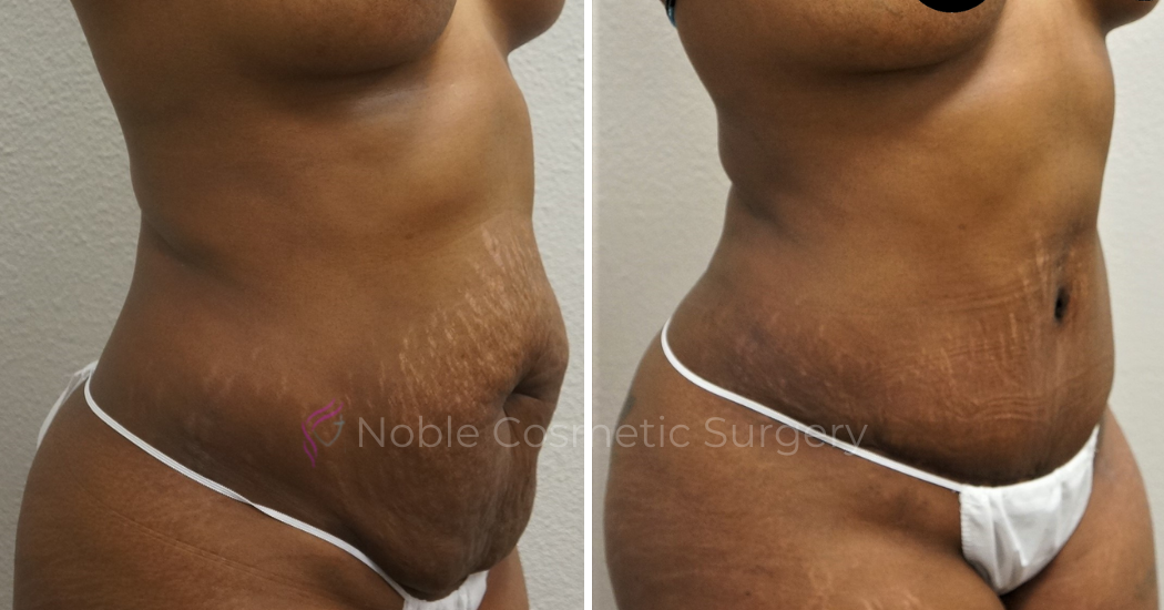 TUMMY-TUCK-CASE-00046 | Before and After Abdominoplasty 2